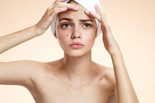Playa del Carmen anti-acne skin treatment certified esthetician Skinbar by Andrea Zuñiga