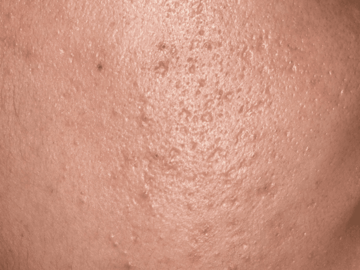 Gwan Peel - Deep Renewal Hyperpigmentation / Acne Scars - Image 2
