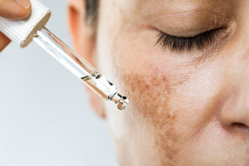 Playa del Carmen carboxy therapy treatment for melasma or hyperpigmentation by certified esthetician Skinbar by Andrea Zuñiga